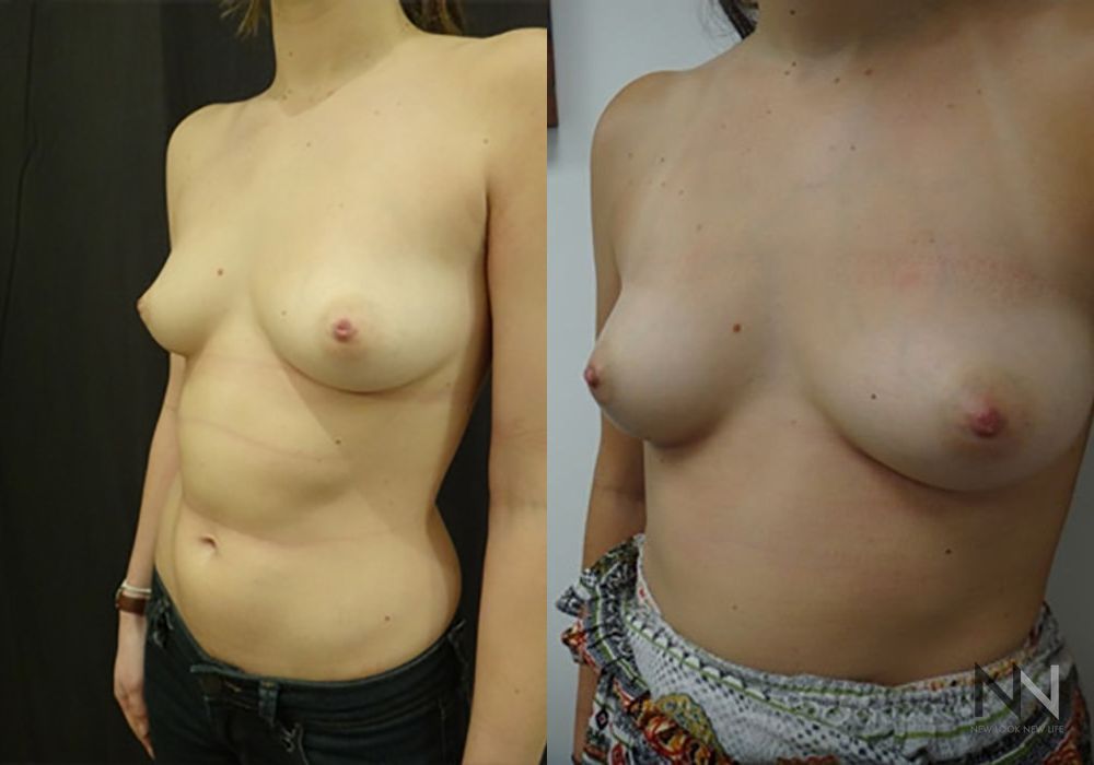 Inverted Nipple Surgery - Thumbnail 4