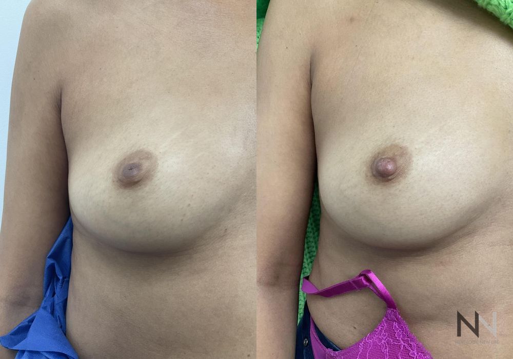 Inverted Nipple Surgery - Case 1872