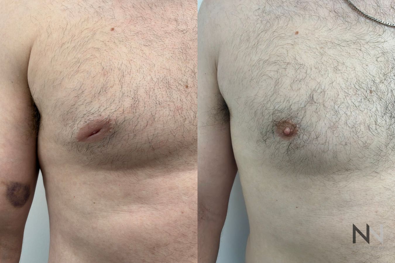 Side-by-side before-and-after photographs of a 37-year-old male patient, showing bilateral inverted nipples before surgery and improved nipple projection after correction. - Angle 2