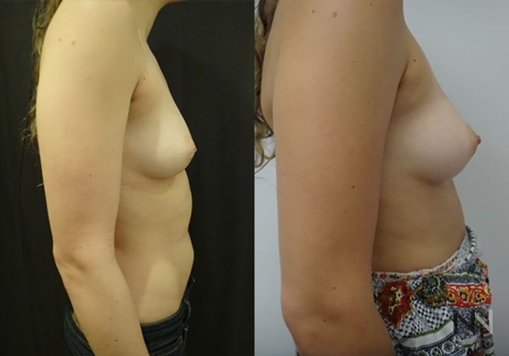 Inverted Nipple Surgery - Thumbnail 3