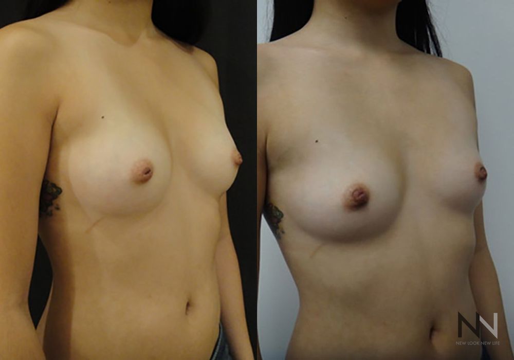 Inverted Nipple Surgery - Thumbnail 2