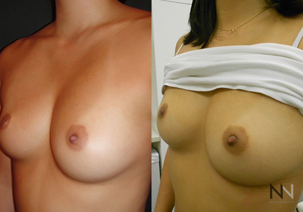 Inverted Nipple Surgery - Thumbnail 3