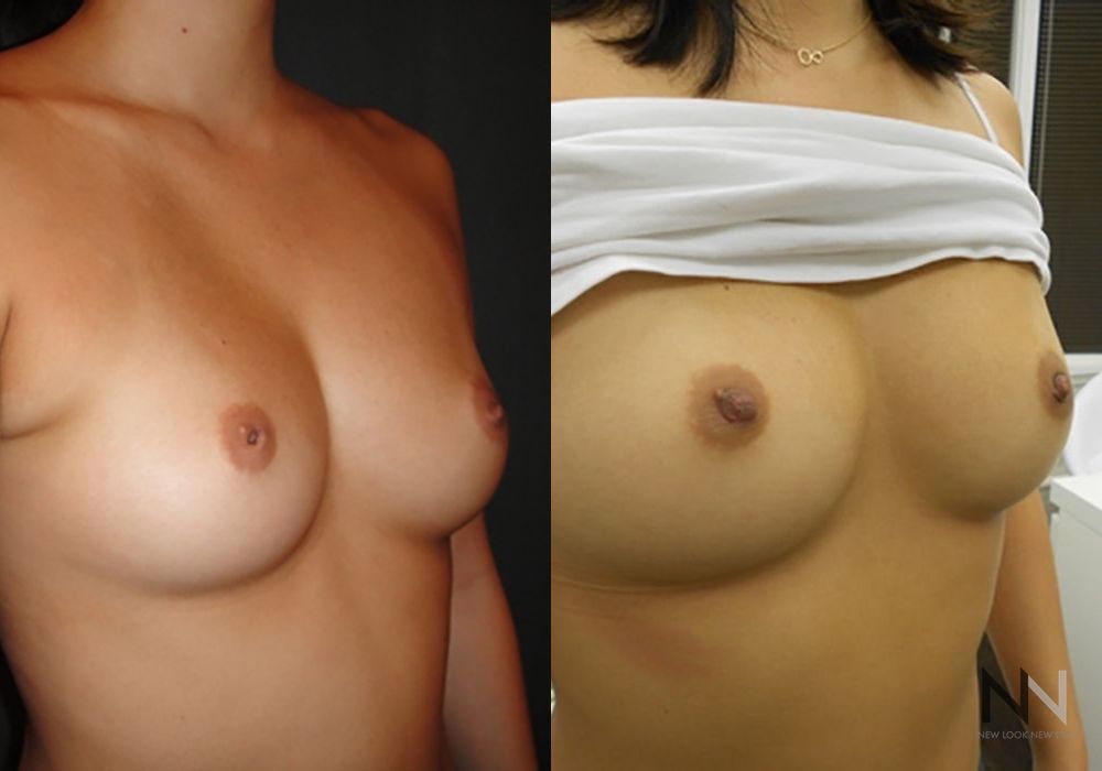 Inverted Nipple Surgery - Thumbnail 2