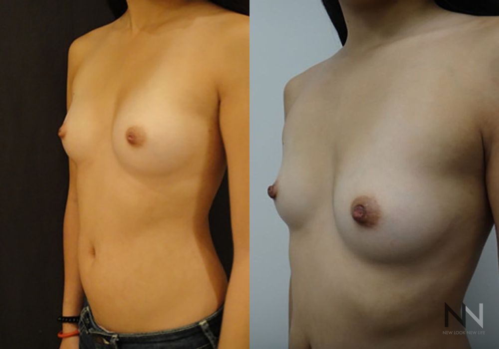 Inverted Nipple Surgery - Thumbnail 3