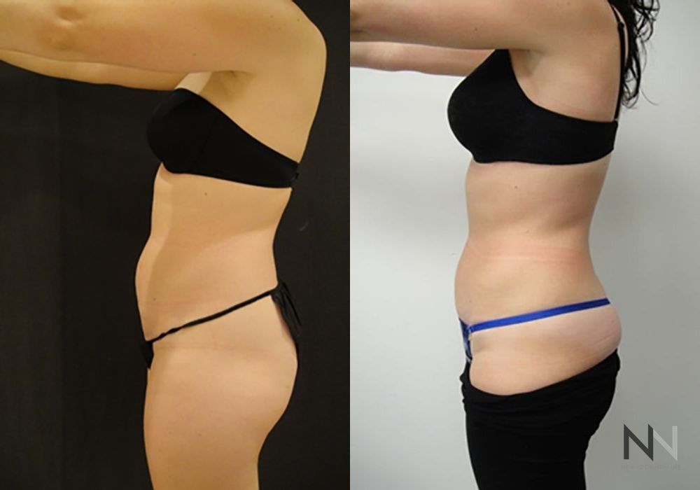 Liposuction - Thumbnail 3