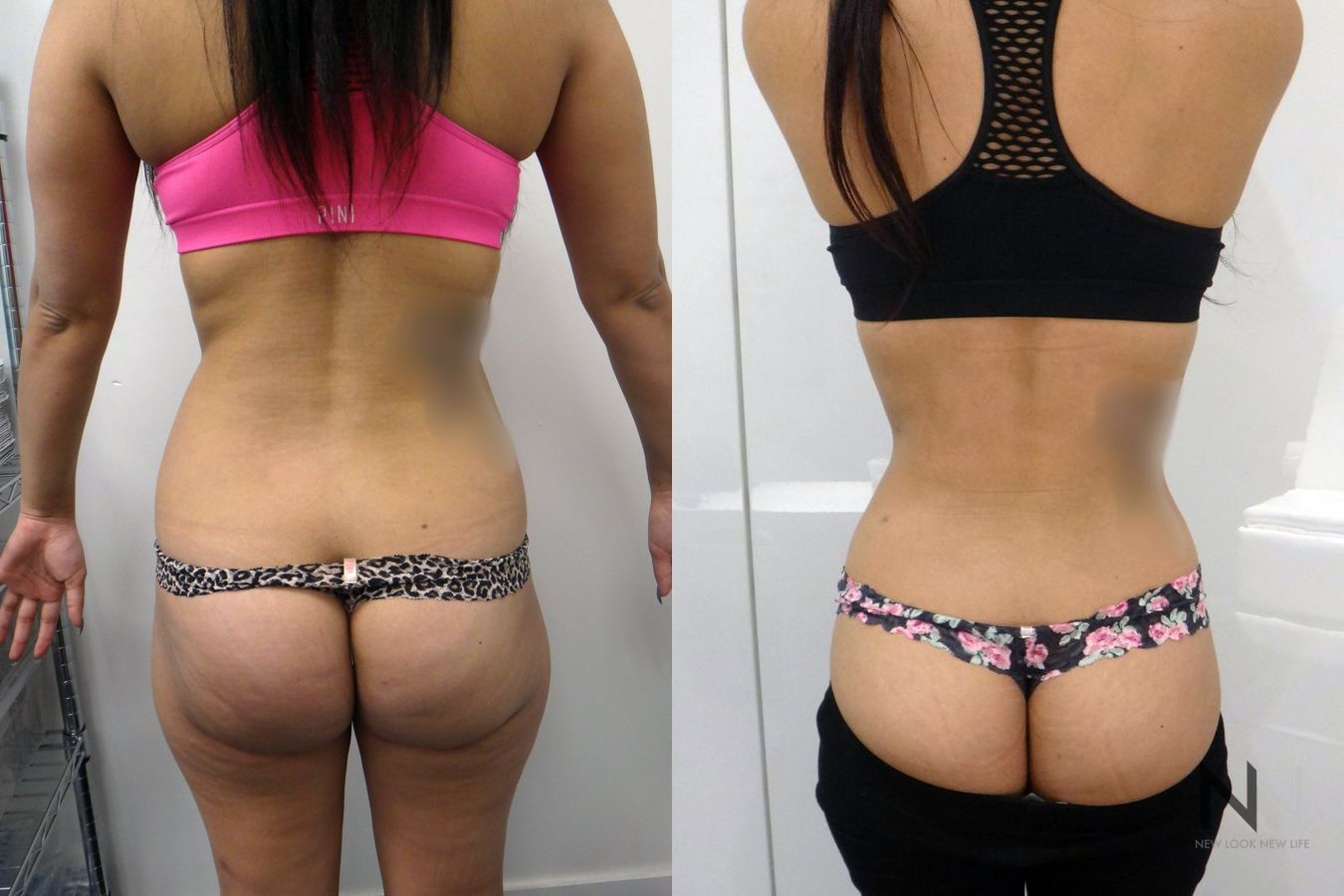Awake liposuction showing improved waistline contour - Angle 4