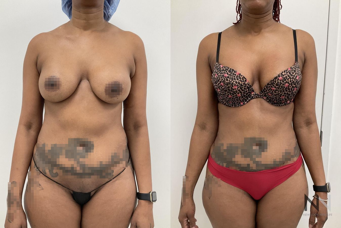 Before and after VASER liposuction with J-Plasma six months results - Angle 2