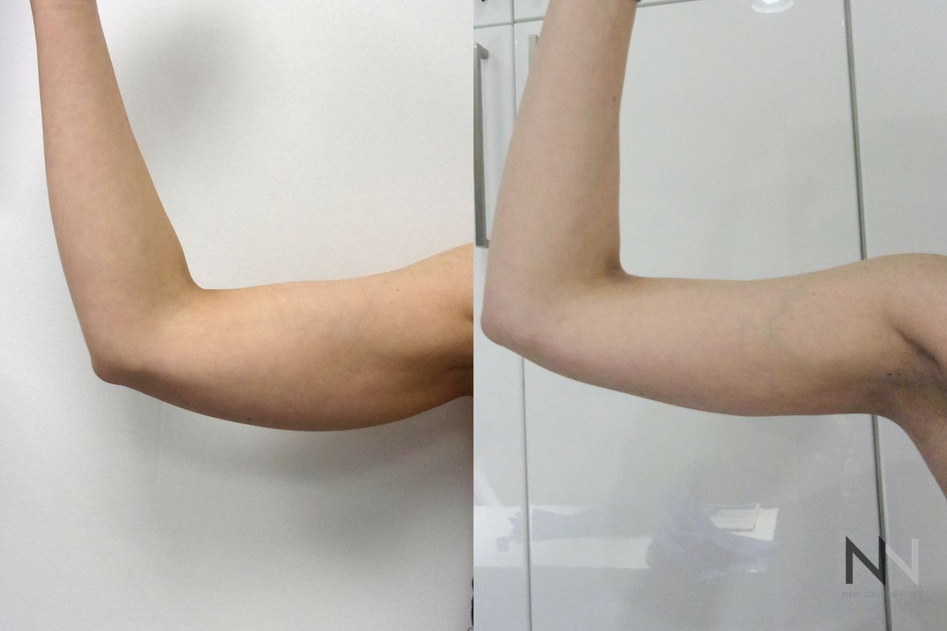 Before and after arm liposuction six months results
