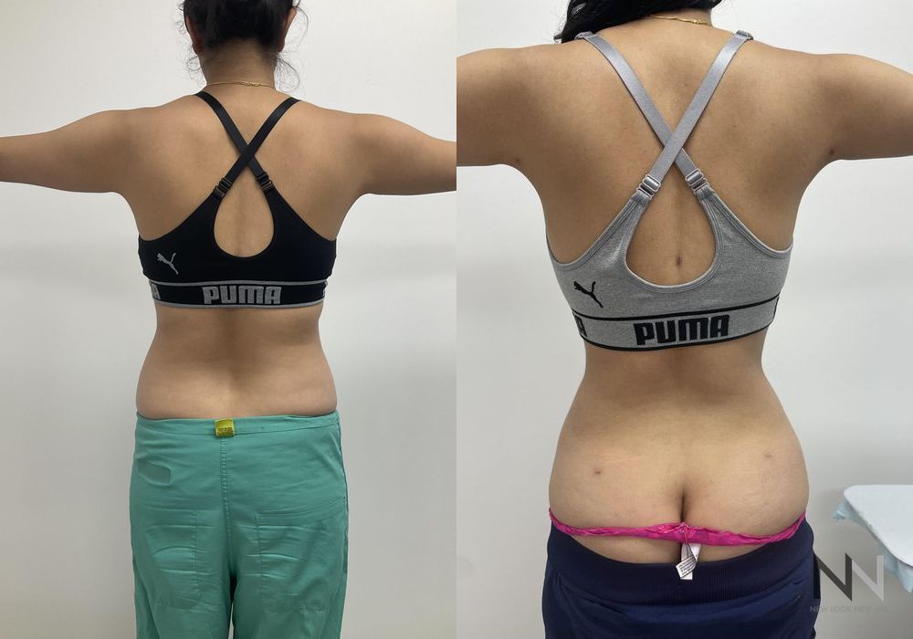 Liposuction - Thumbnail 2