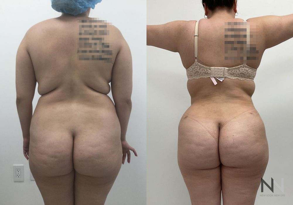 Liposuction - Thumbnail 3