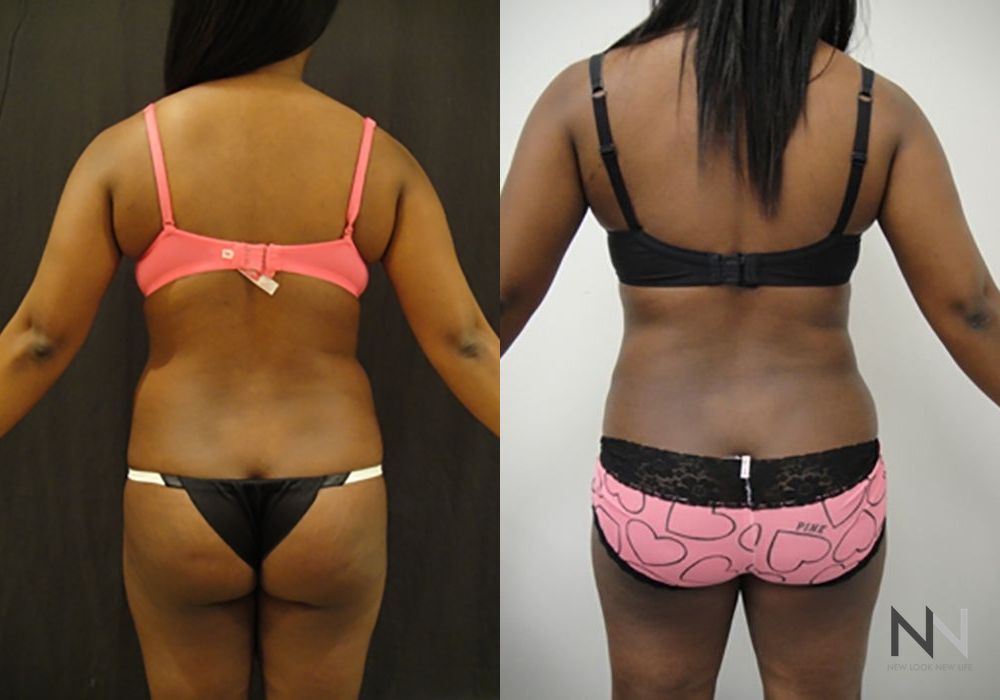 Liposuction - Thumbnail 4