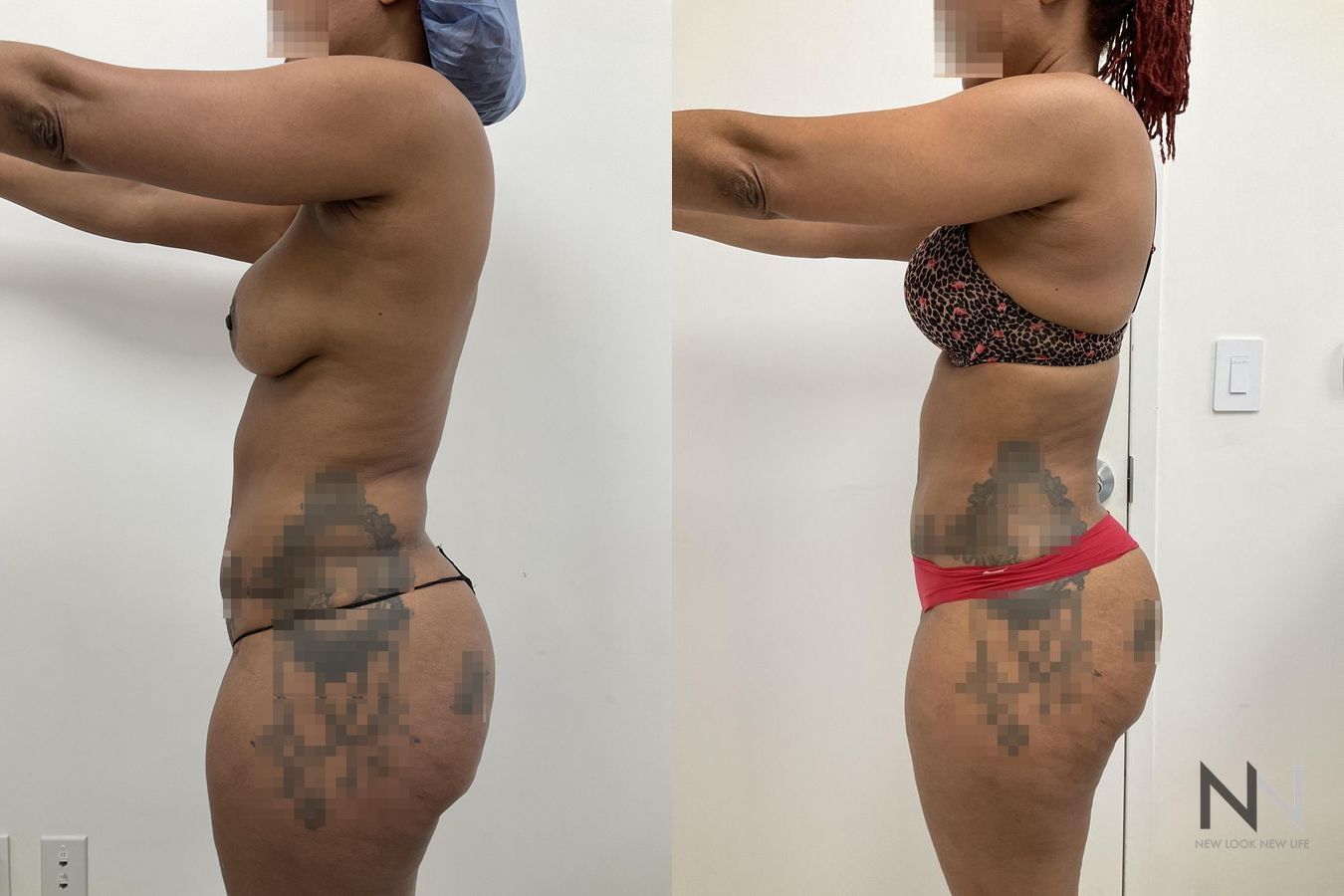 Before and after VASER liposuction with J-Plasma six months results