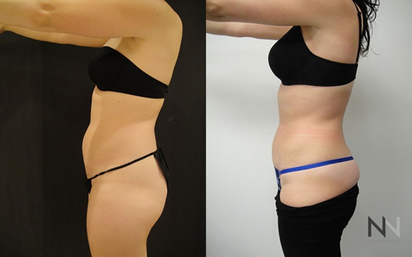 Before and after liposuction six months results - Angle 2