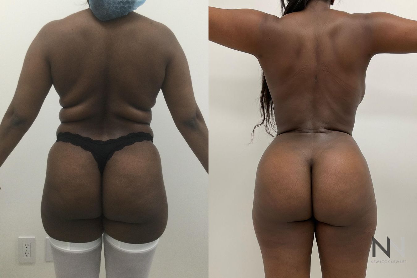 Before and after Lipo 360 six months results - Angle 2