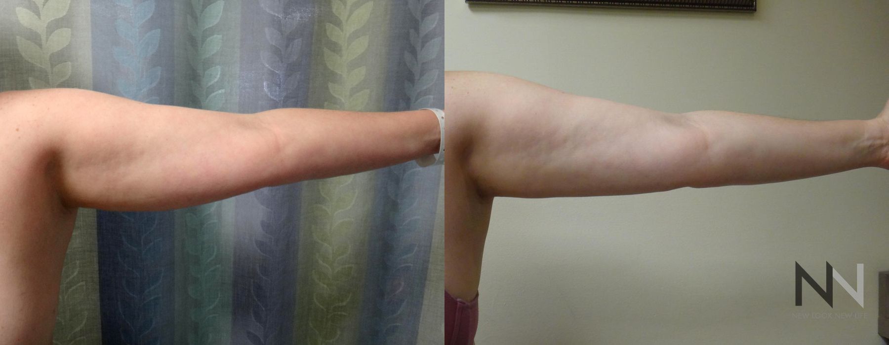 Liposuction - Thumbnail 3