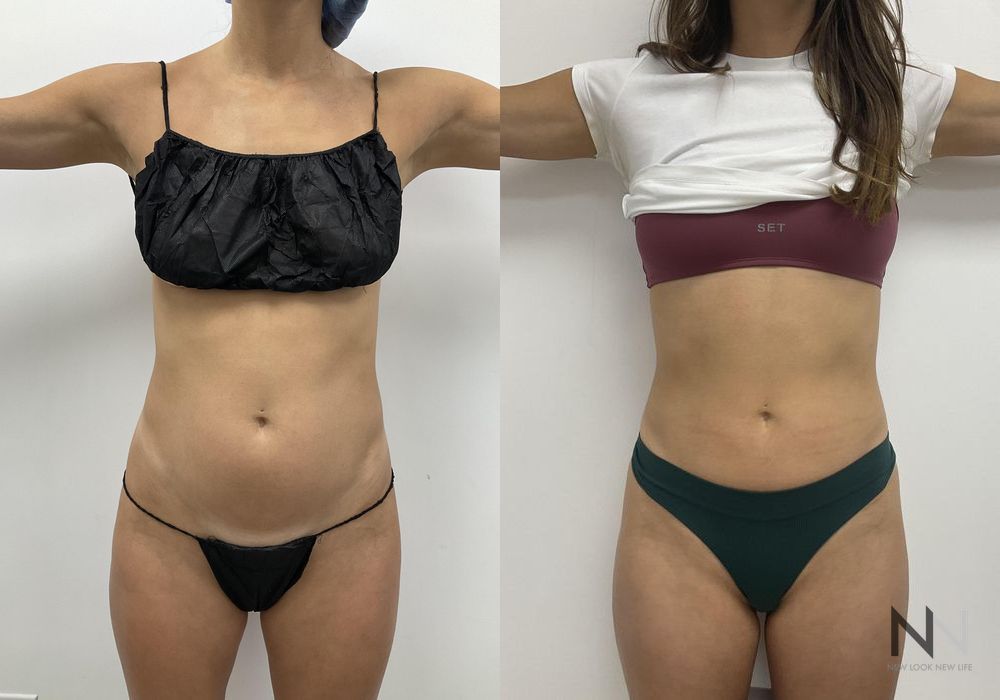 Liposuction - Case 2059