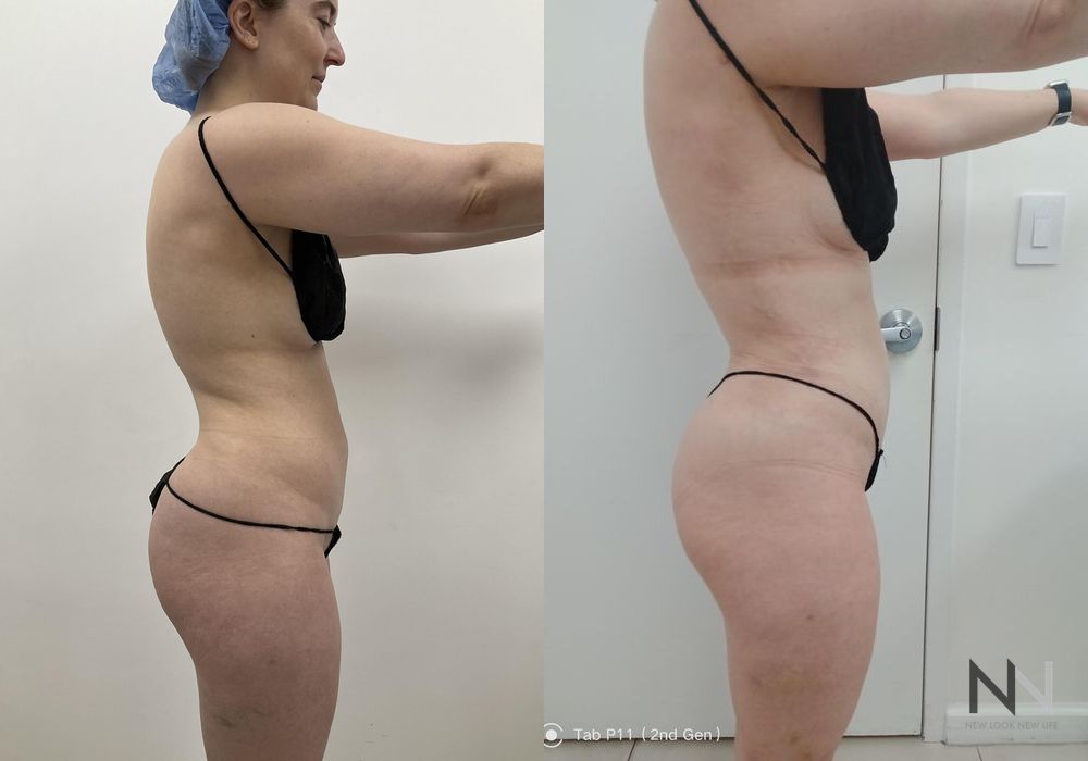 Liposuction - Thumbnail 2