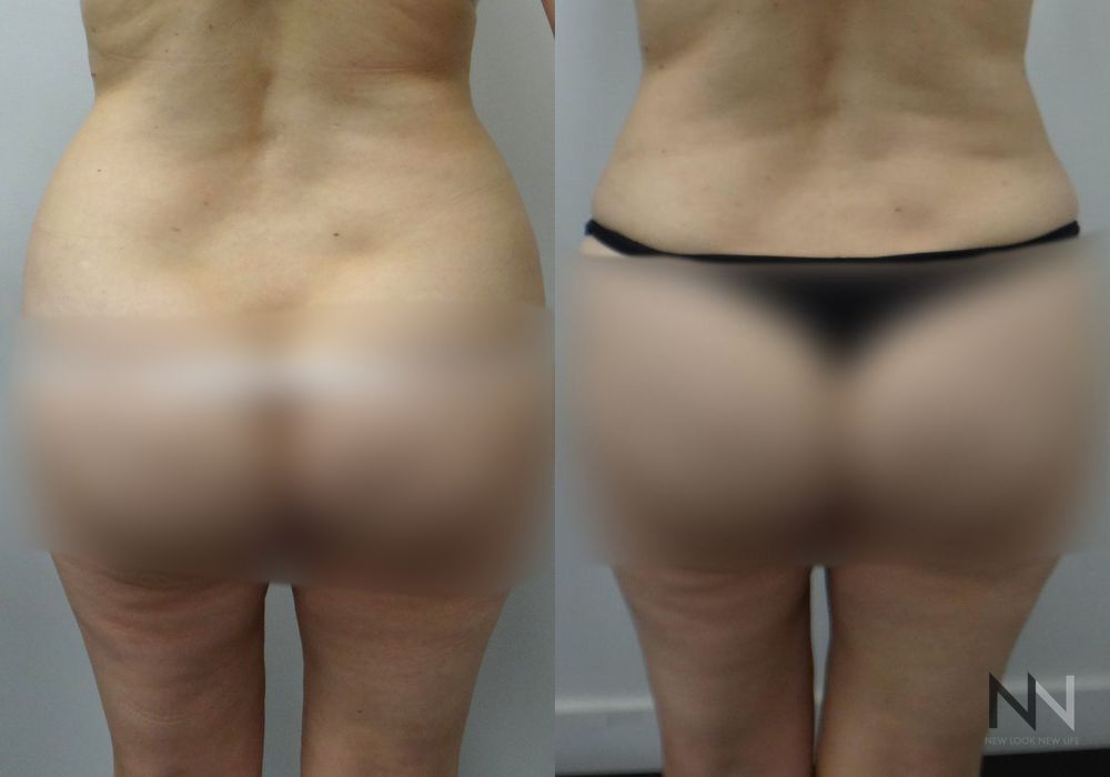 Liposuction - Thumbnail 2