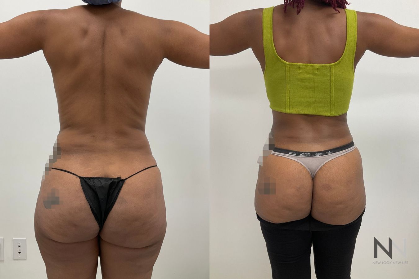 Back view before and after female liposuction highlighting significant flank reduction and an accentuated hourglass shape by Dr. Claudia Kim in NYC. - Angle 4