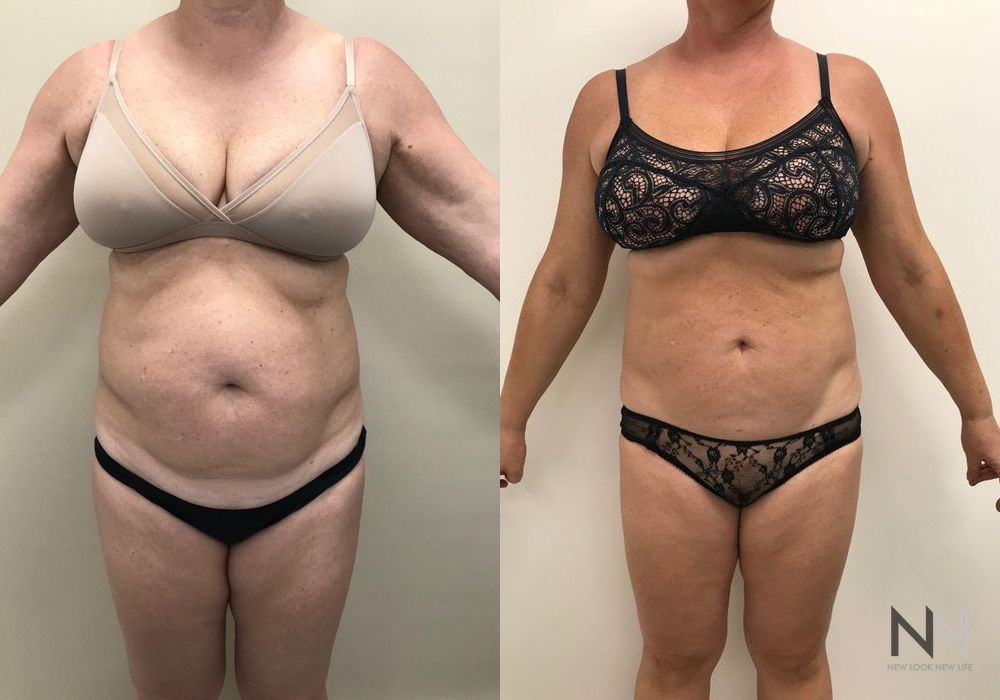Liposuction - Case 1878