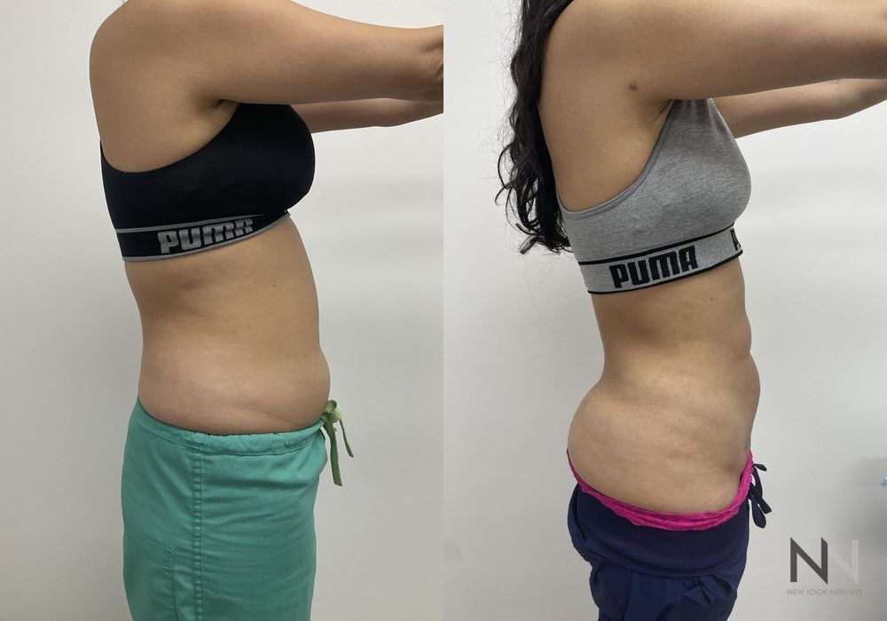 Liposuction - Thumbnail 4