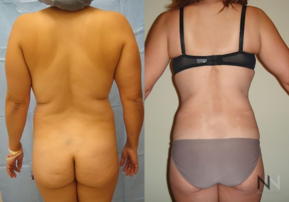 Liposuction - Thumbnail 4