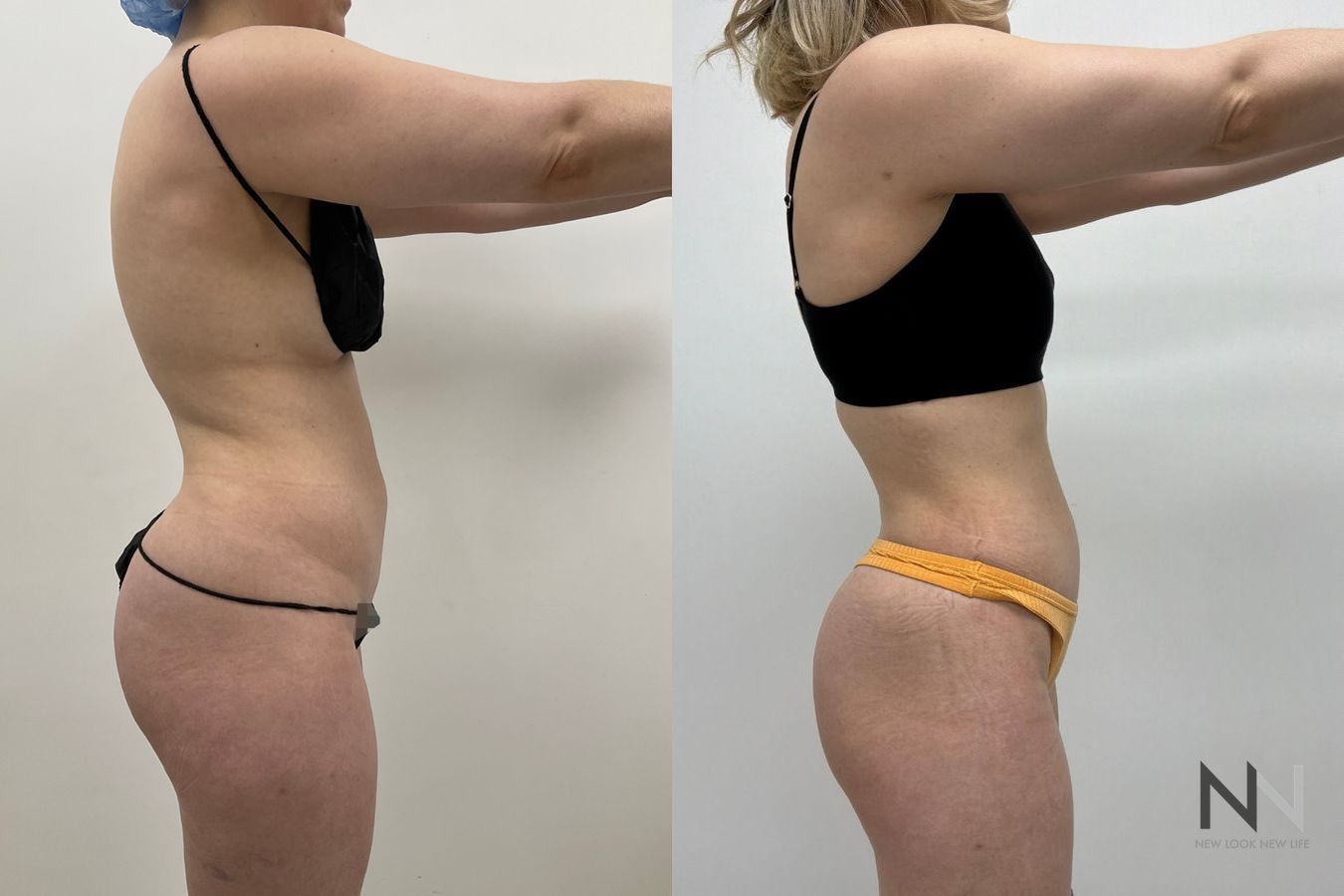 Liposuction 360 before and after showing abdominal, flank, back, and waist contouring by Dr. Claudia Kim in Manhattan, NYC - Angle 4