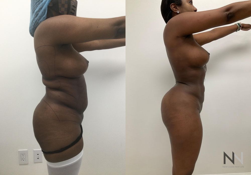 Liposuction - Thumbnail 4