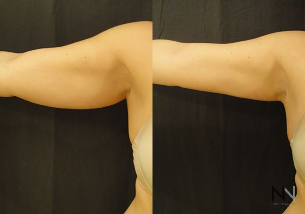 Liposuction - Thumbnail 2