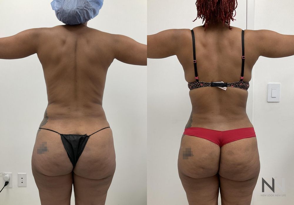 Liposuction - Thumbnail 2