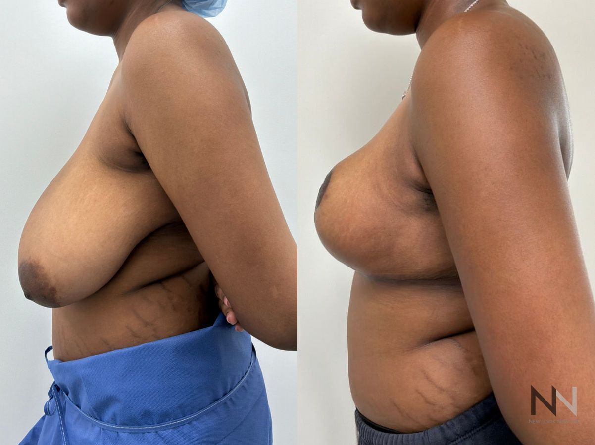 Breast reduction before and after by Dr. Claudia Kim at New Look New Life in NYC, showing improved breast size, shape, and overall body proportions. - Angle 4