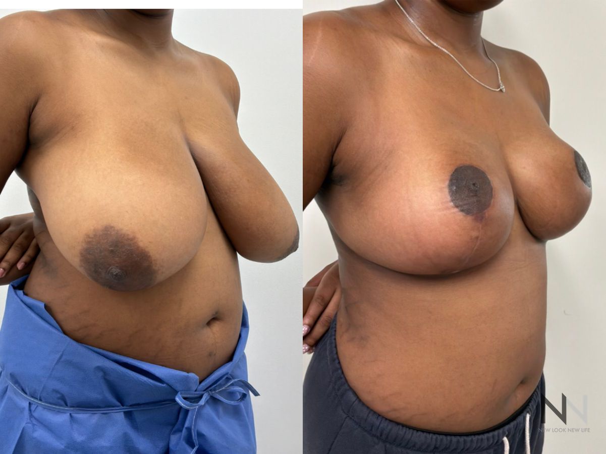 Breast reduction before and after by Dr. Claudia Kim at New Look New Life in NYC, showing improved breast size, shape, and overall body proportions. - Angle 3