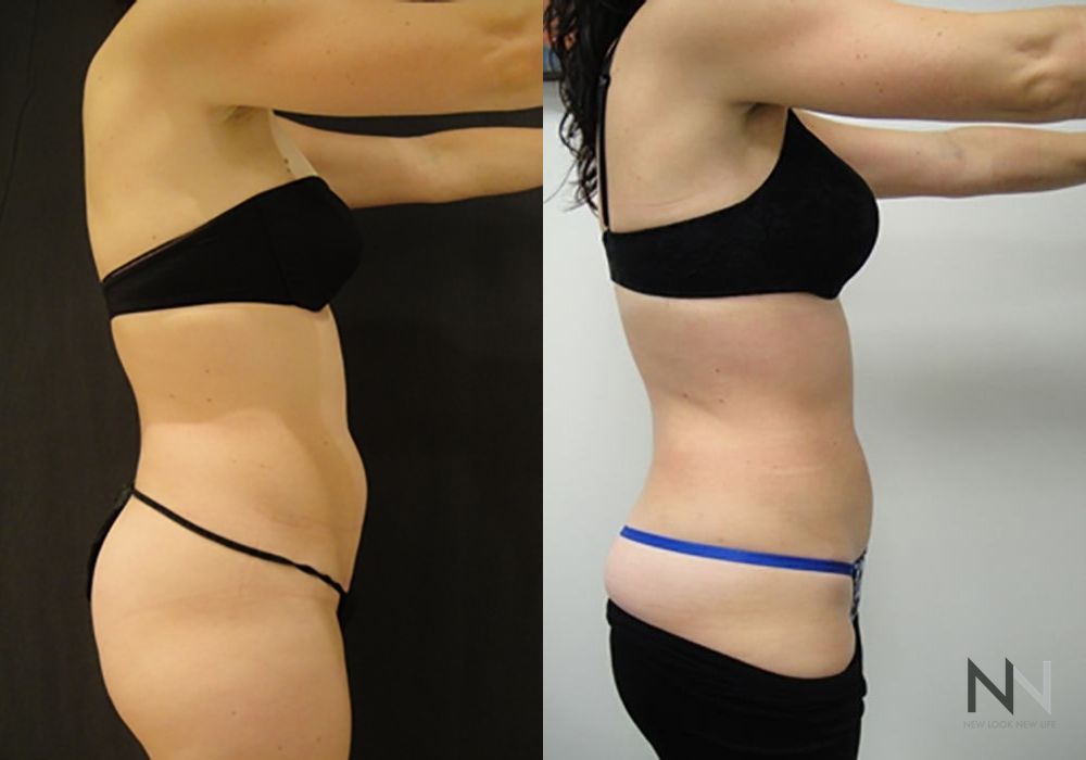 Liposuction - Case 1880