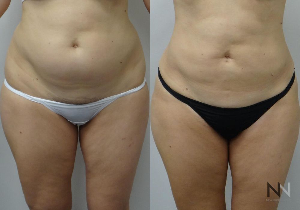 Liposuction - Case 1883