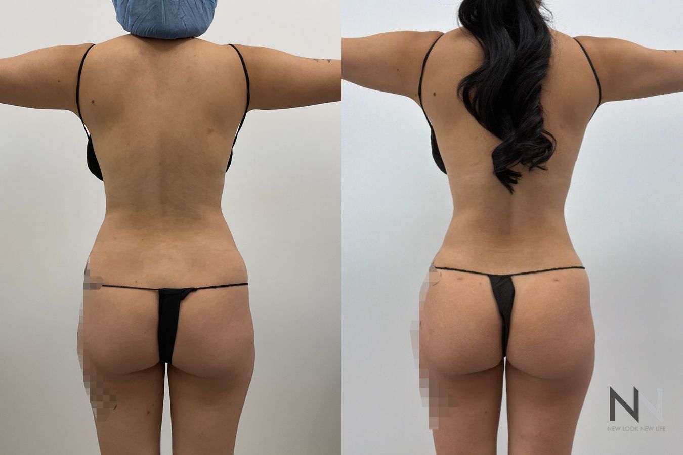 Liposuction before and after showing improved abdominal, flank, back and arm contours by Dr. Claudia Kim in NYC. - Angle 2
