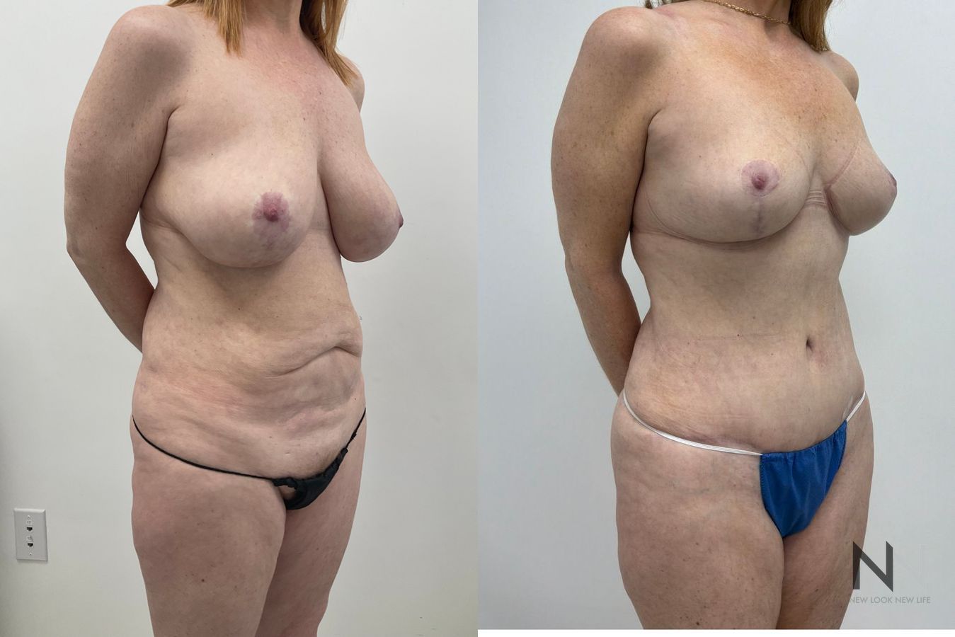 Tummy tuck before and after showing improved abdominal contours and removal of excess abdominal skin by Dr. Claudia Kim in NYC - Angle 3