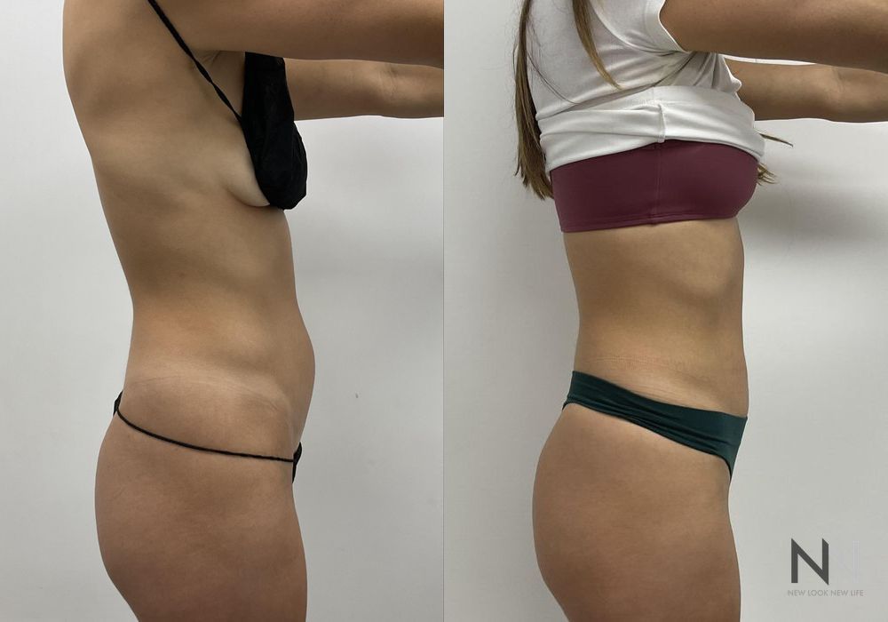 Liposuction - Thumbnail 2