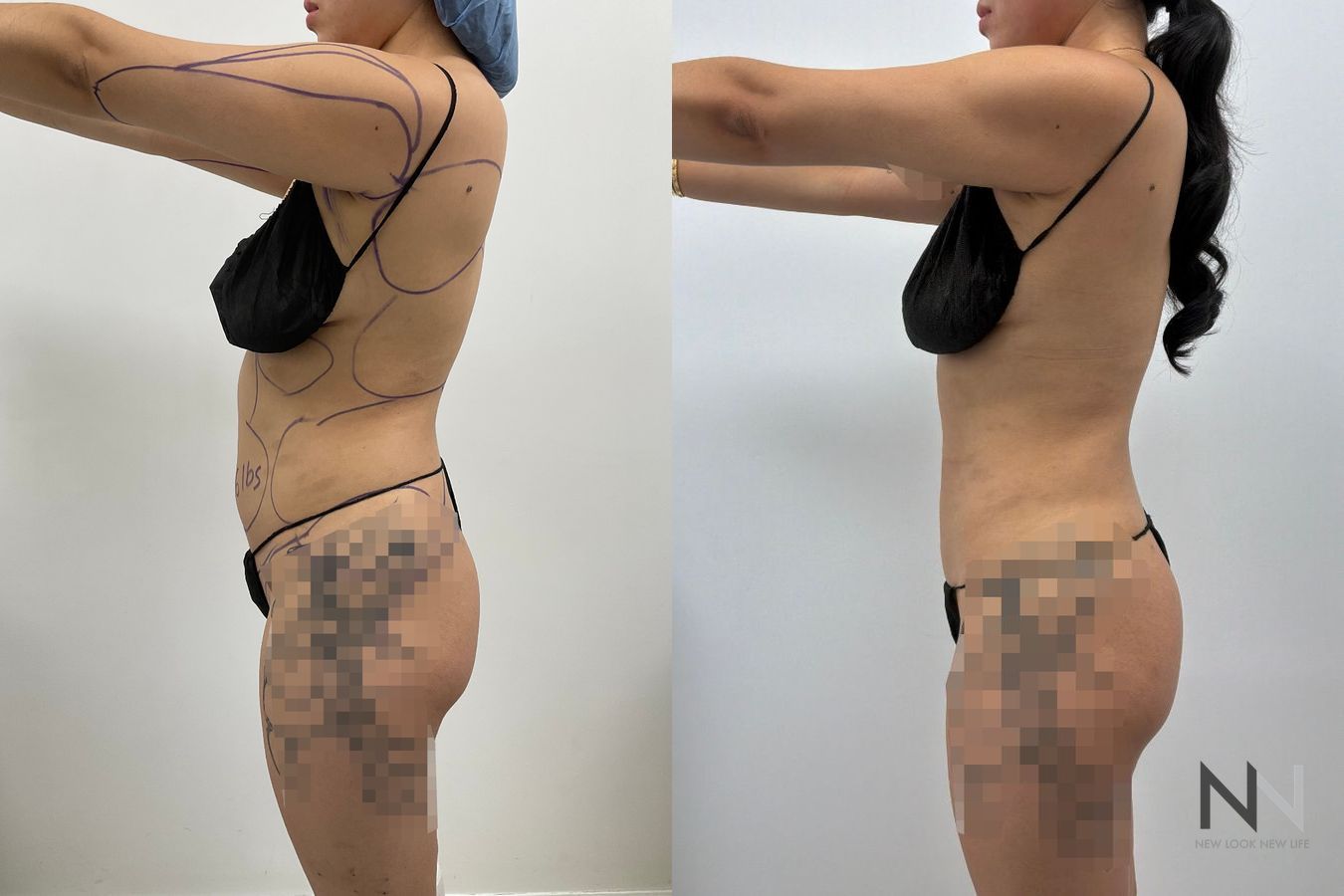 Liposuction before and after showing improved abdominal, flank, back and arm contours by Dr. Claudia Kim in NYC. - Angle 3