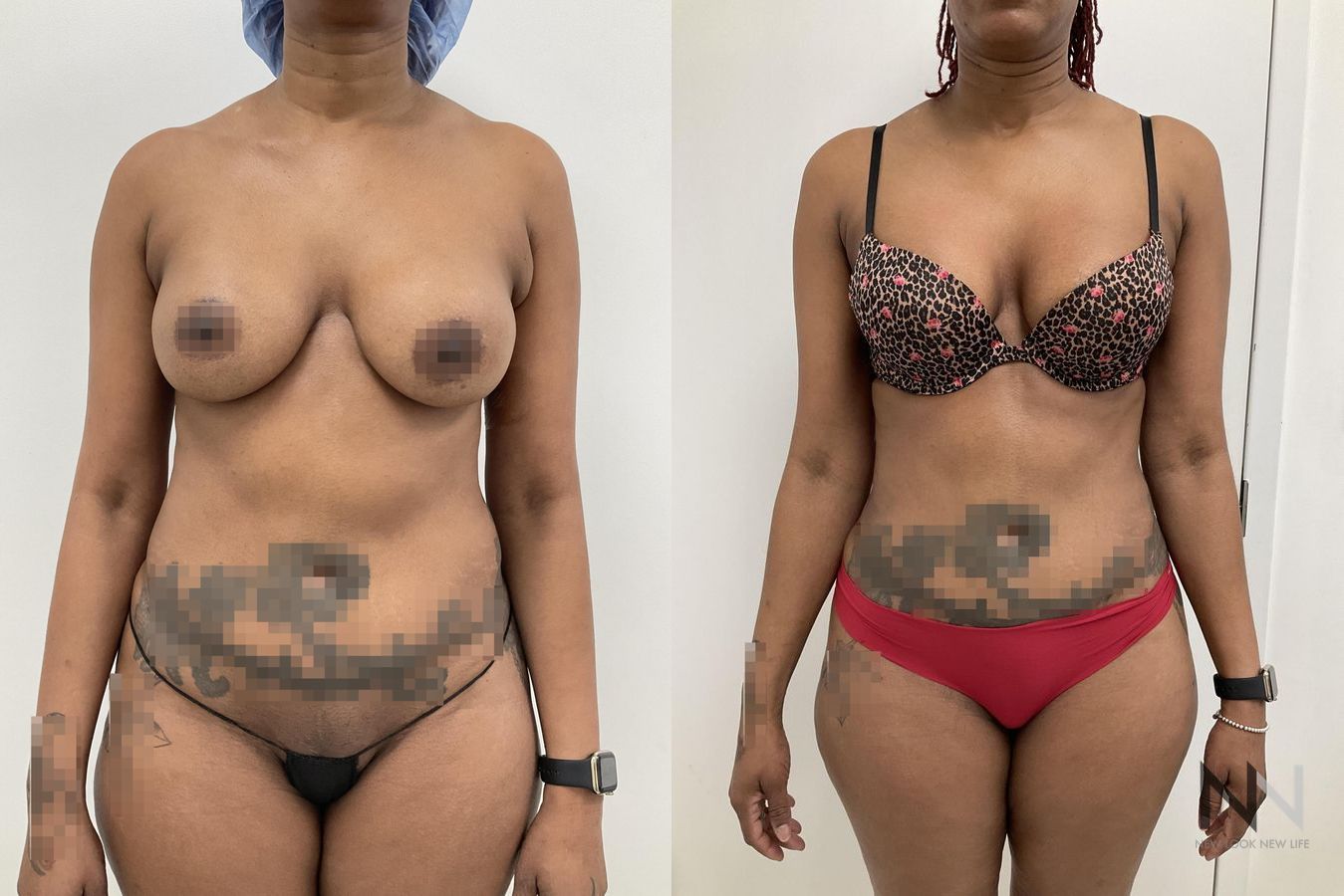 Before and after VASER liposuction with J-Plasma six months results - Angle 2