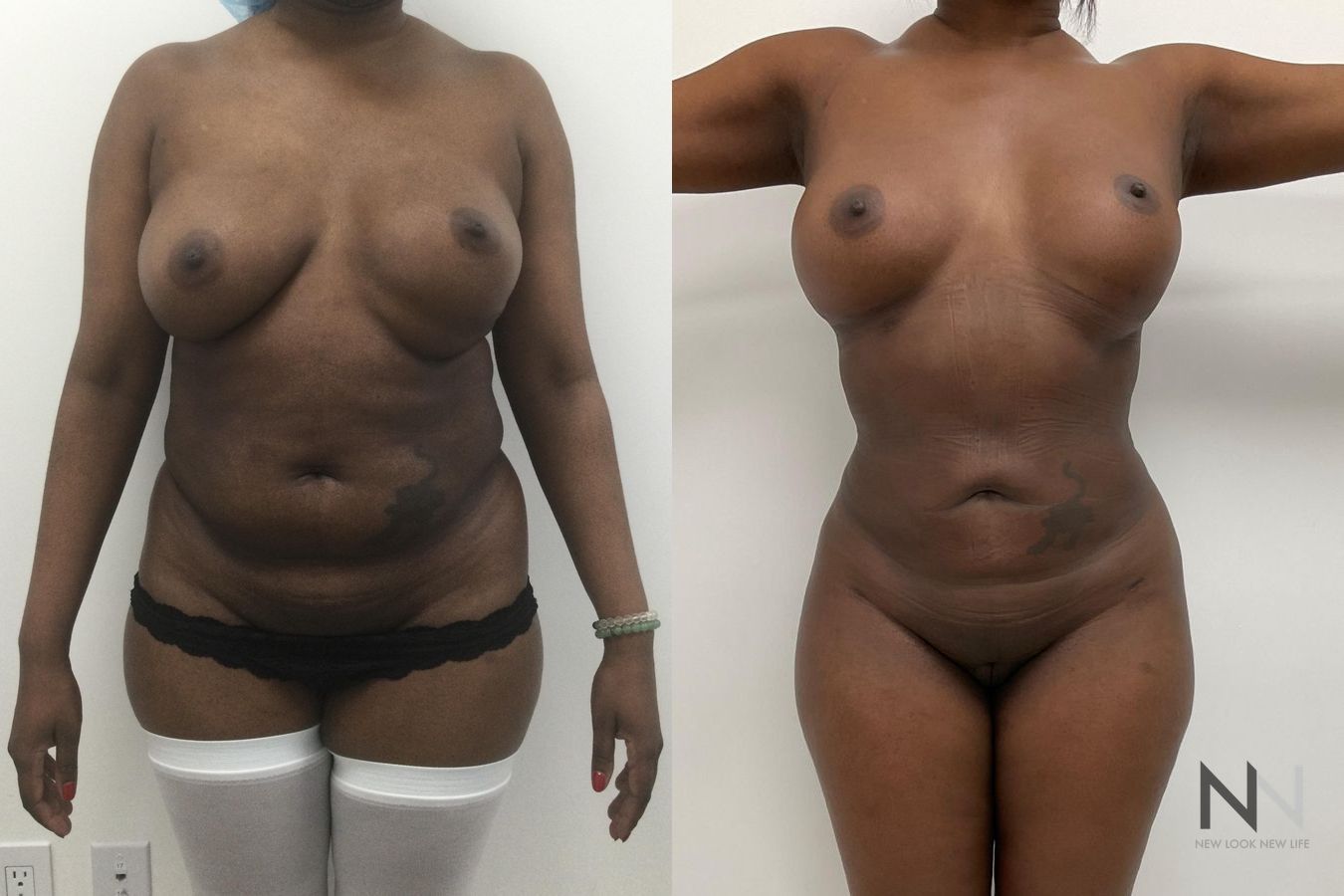 Before and after Lipo 360 six months results