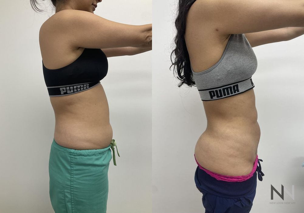 Liposuction - Thumbnail 4