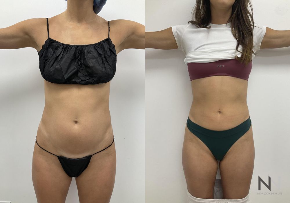 Liposuction - Thumbnail 3