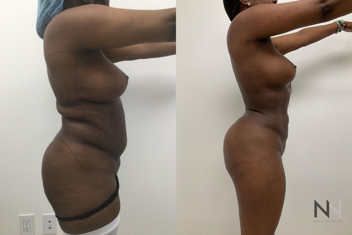 Before and after Lipo 360 six months results - Angle 4