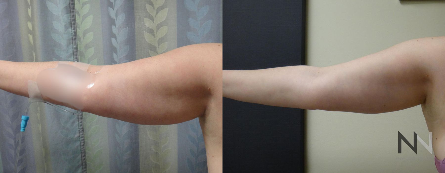 Liposuction - Thumbnail 2