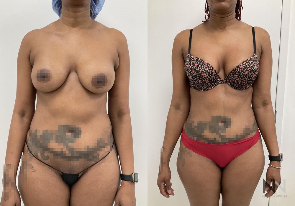 Liposuction - Thumbnail 4