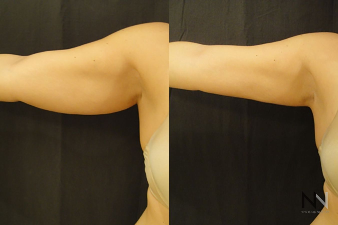 Upper arm liposuction showing improved contour