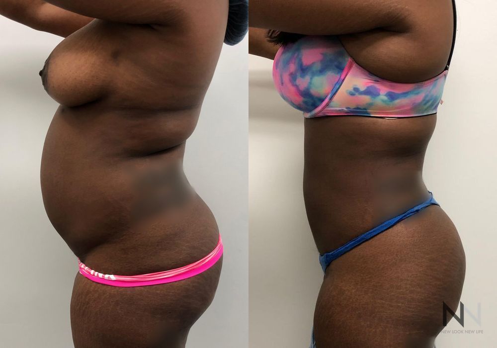 Liposuction - Thumbnail 2