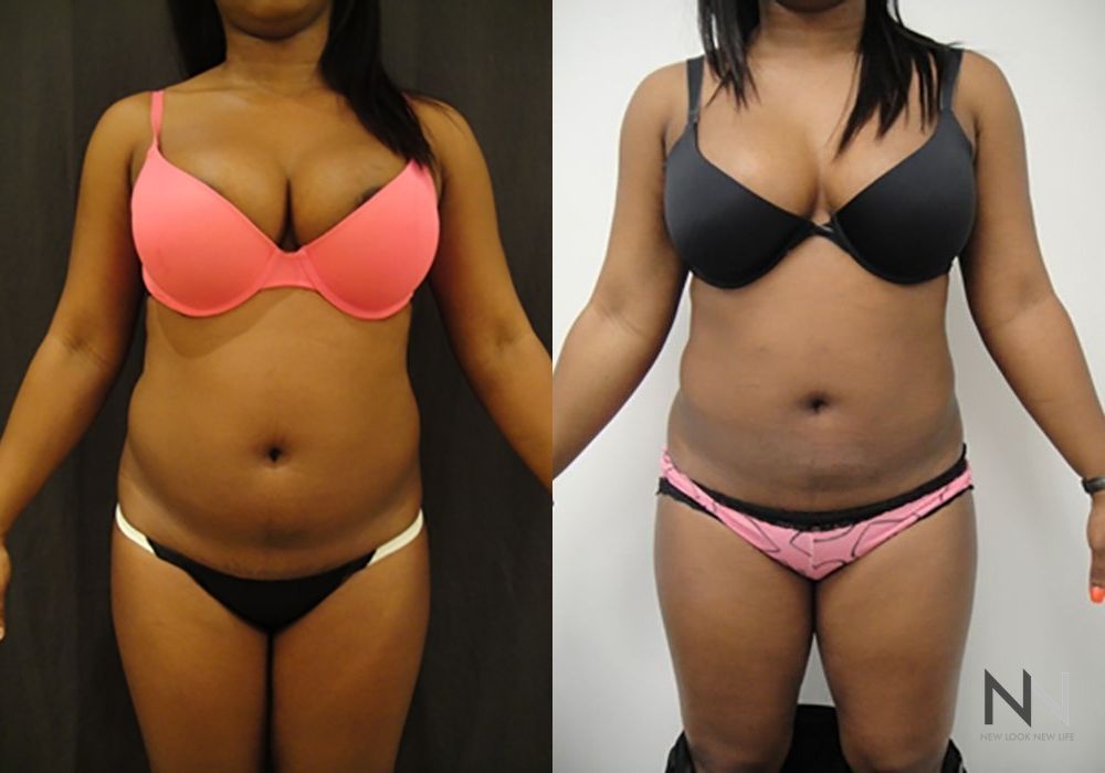 Liposuction - Case 1874