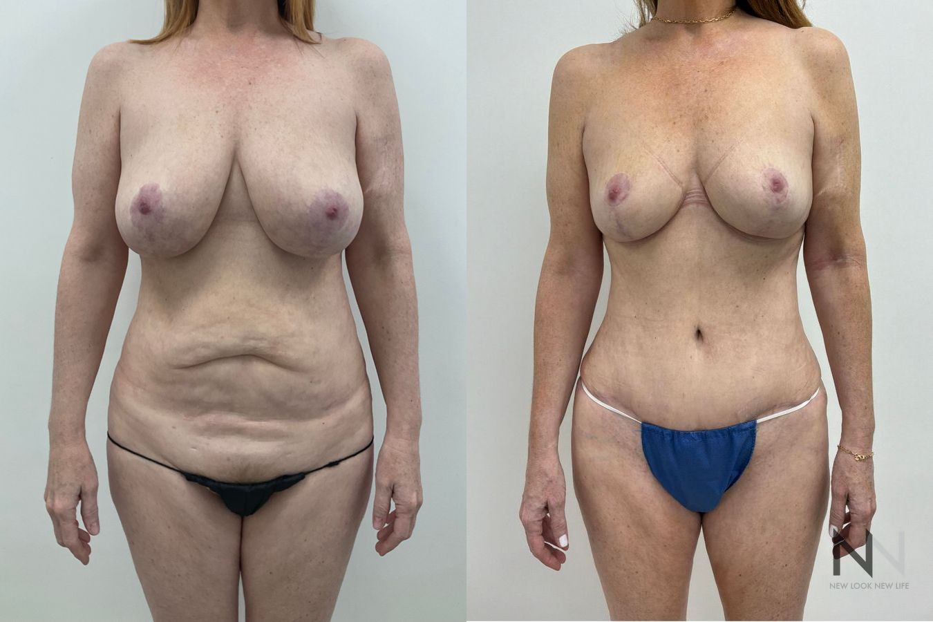 Flank liposuction before and after showing refined waistline and improved body contours by Dr. Claudia Kim in NYC