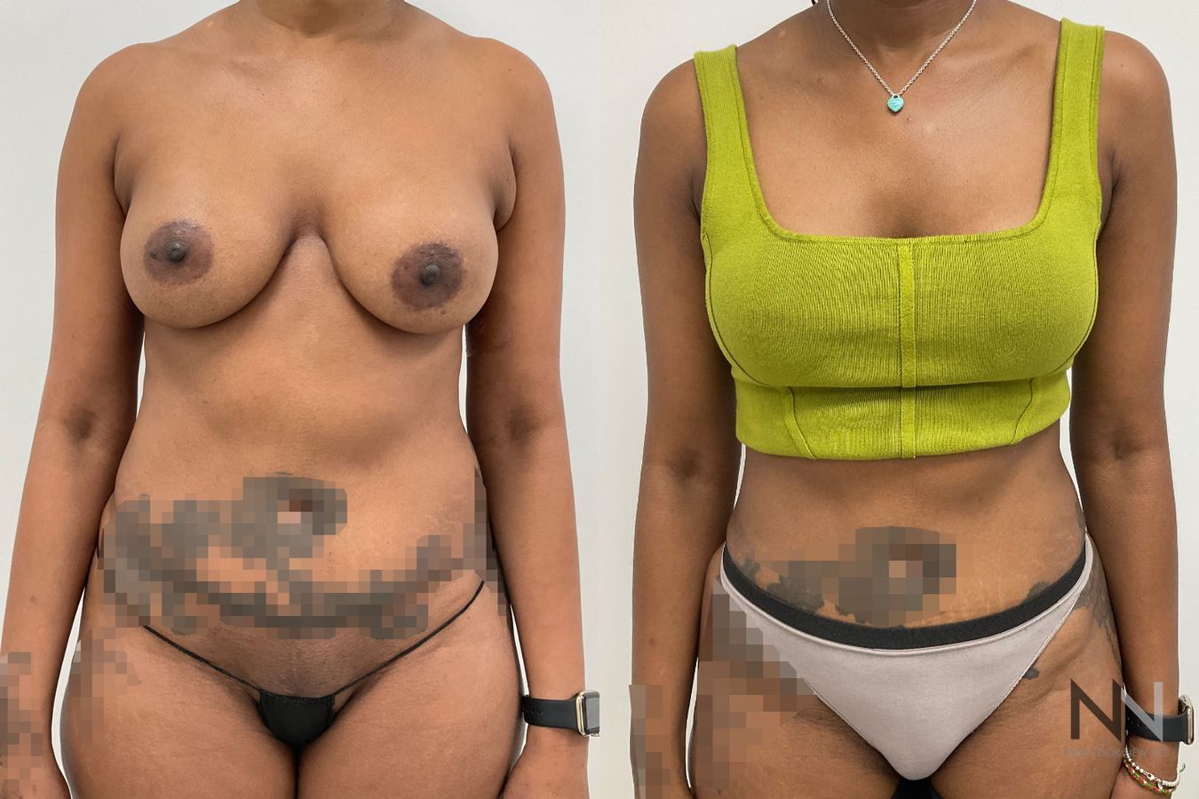 Back view before and after female liposuction highlighting significant flank reduction and an accentuated hourglass shape by Dr. Claudia Kim in NYC.